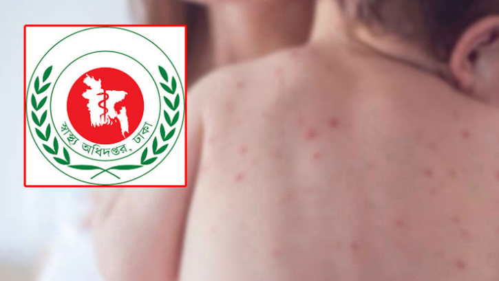 হাম উপসর্গে আরো ৫ প্রাণহানি