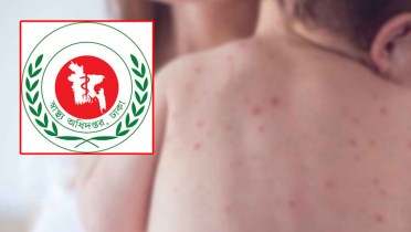 হাম উপসর্গে আরো ৫ প্রাণহানি